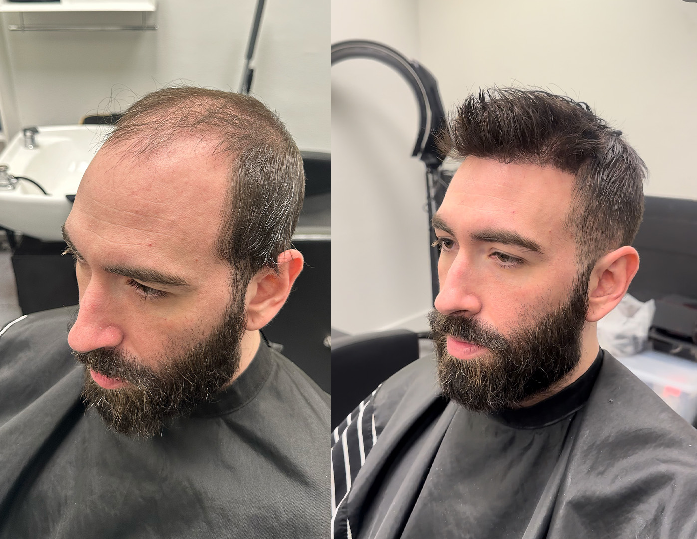 Before and after example of a natural-looking men's hair system