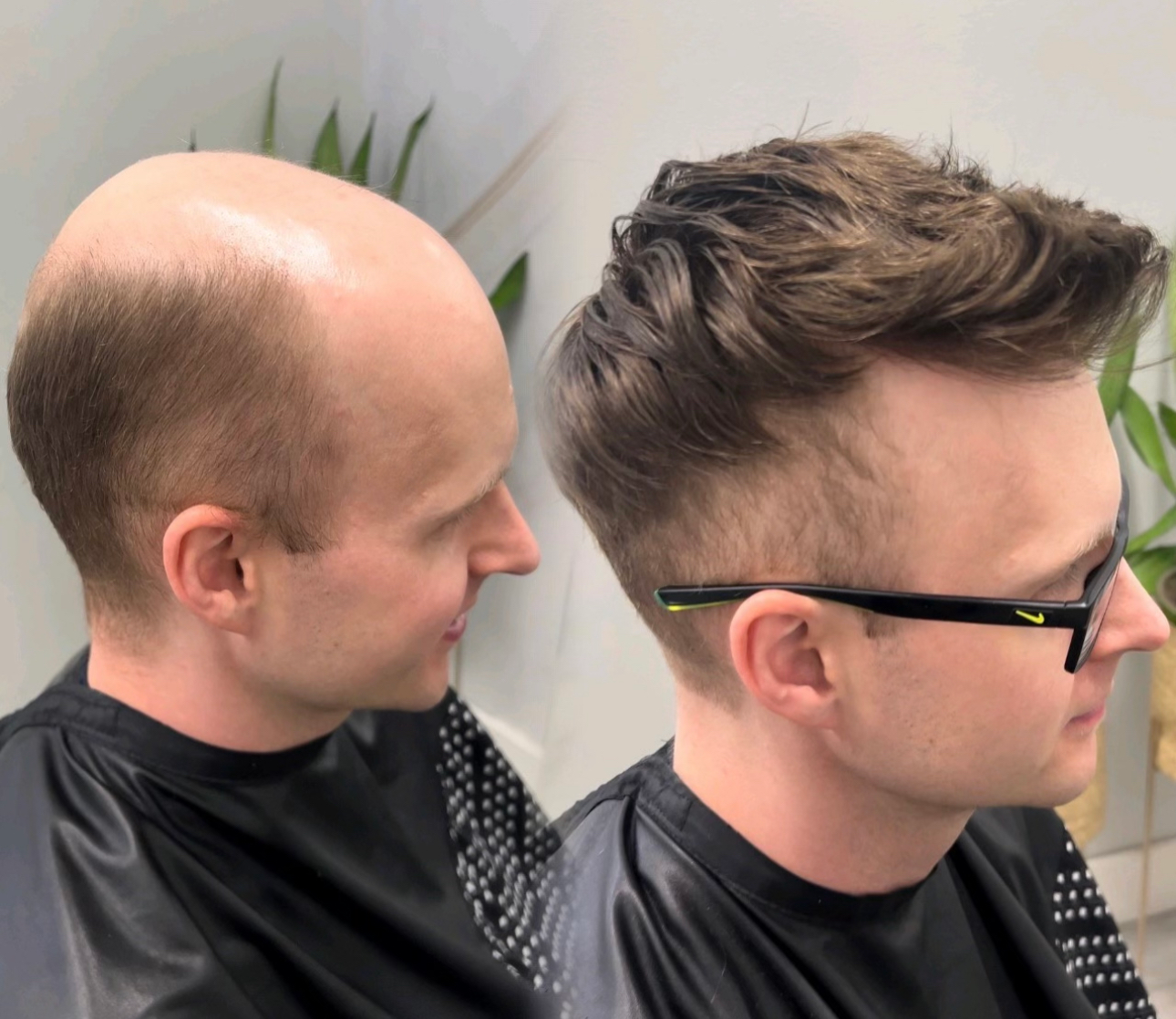 Before and after hair replacement example